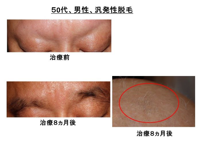 円形脱毛症　病院